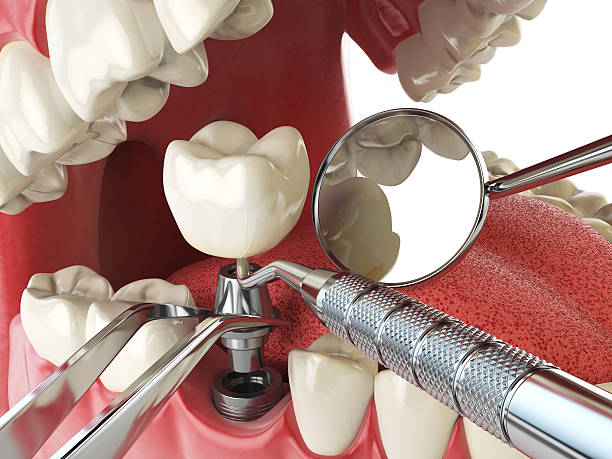 Best Emergency Root Canal Therapy in Trenton, MO